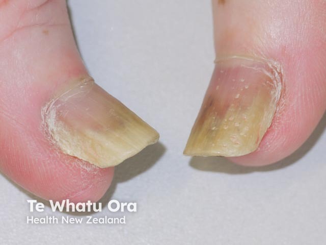 Psoriatic nail dystrophy