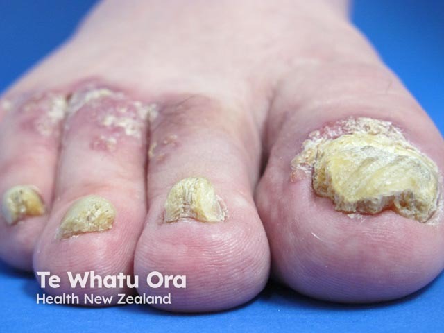 Psoriatic nail dystrophy