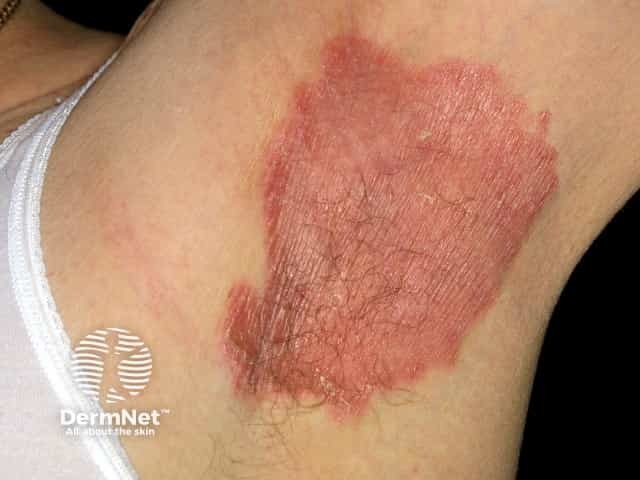 Axillary psoriasis