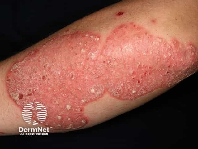 Chronic plaque psoriasis