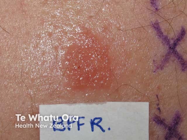 Positive patch test to PTBP formaldehyde resin