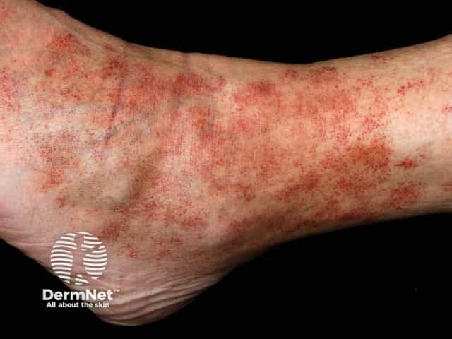 Pigmented purpuric dermatitis