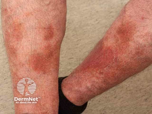 Pigmented purpuric dermatitis