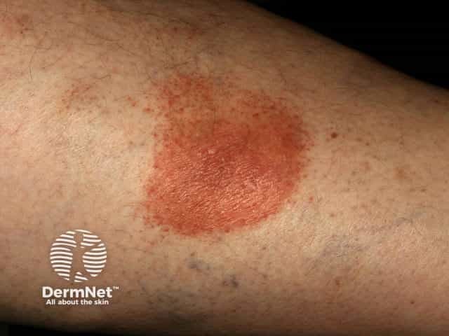 Pigmented purpuric dermatitis