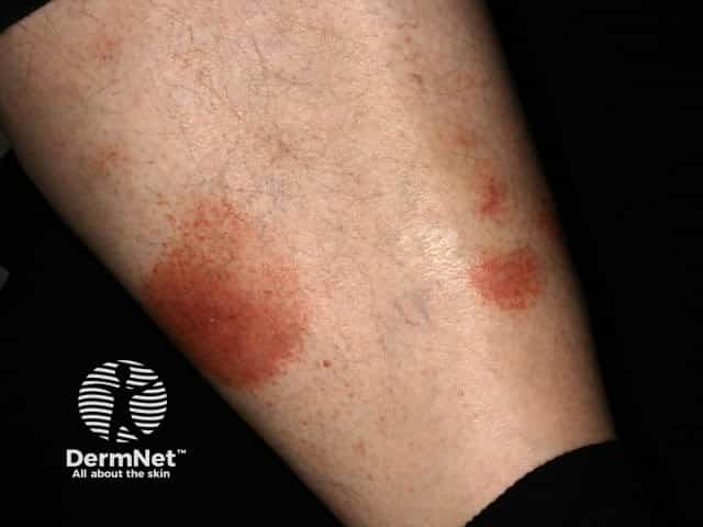 Pigmented purpuric dermatitis