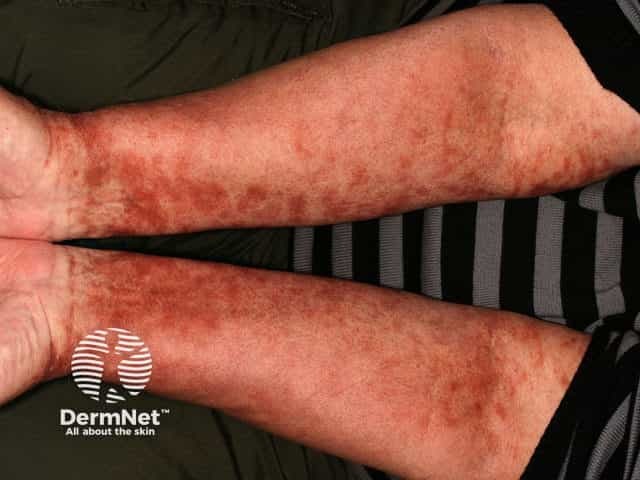 Pigmented purpuric dermatitis