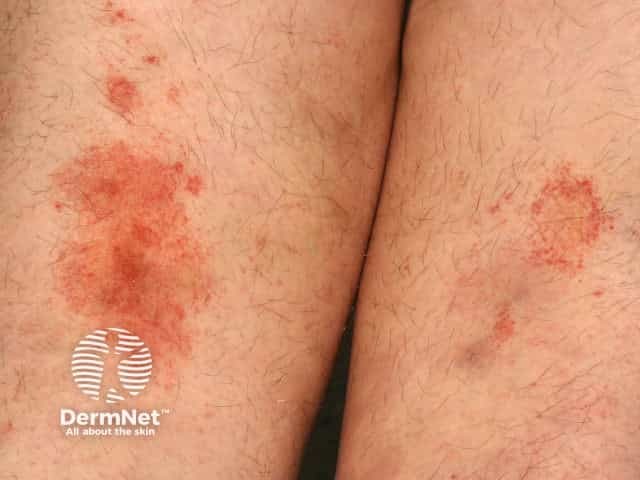 Pigmented purpuric dermatitis