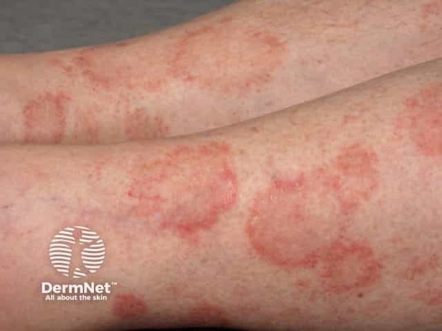 Pigmented purpuric dermatitis