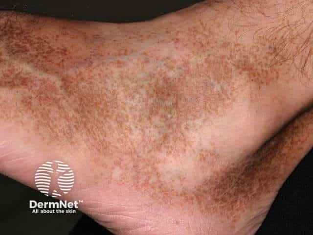 Pigmented purpuric dermatitis