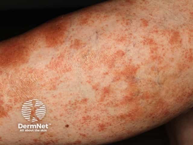 Pigmented purpuric dermatitis