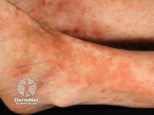 Pigmented purpuric dermatitis