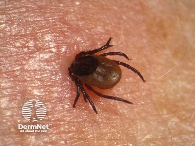 Tick bite