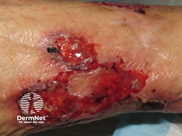 Pyoderma gangrenosum