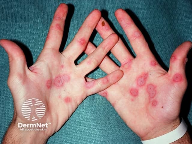 Erythema multiforme