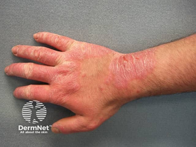 Allergic contact dermatitis to rubber