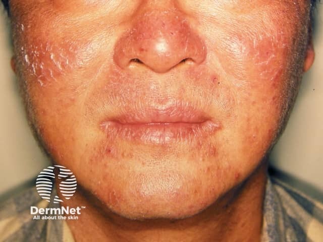 Chronic actinic dermatitis