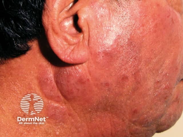 Chronic actinic dermatitis