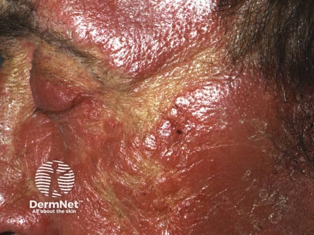 Chronic actinic dermatitis