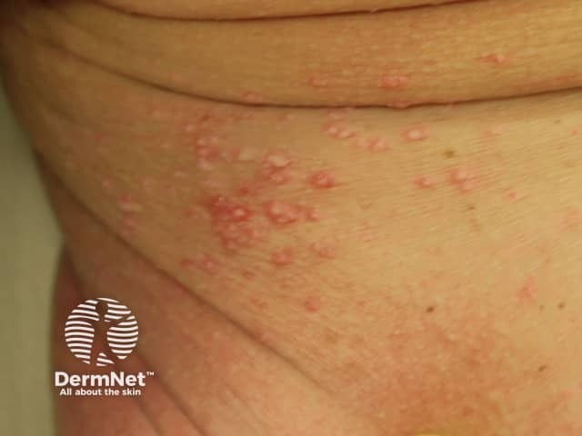 Molluscum contagiosum affecting amputation stump