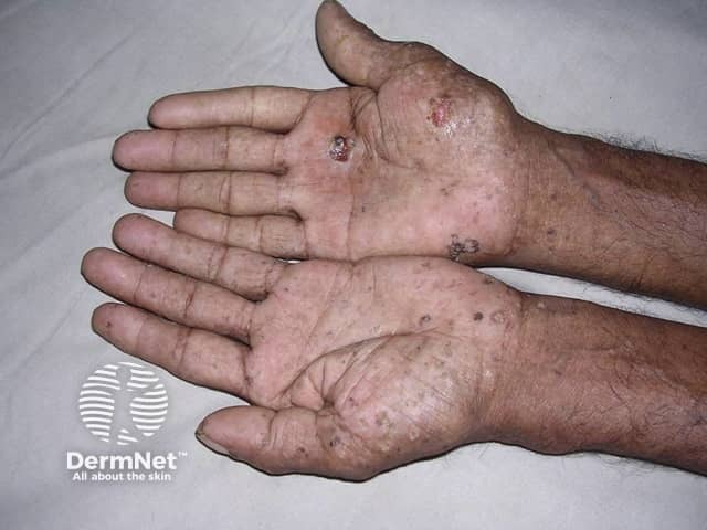 Arsenical keratoses