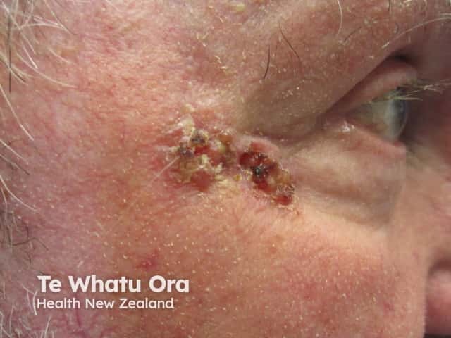 Basal cell carcinoma