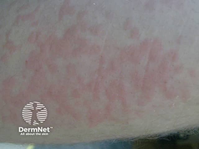 Cold urticaria