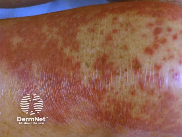 Dermal contact dermatitis