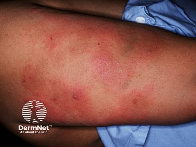 Dermal contact dermatitis