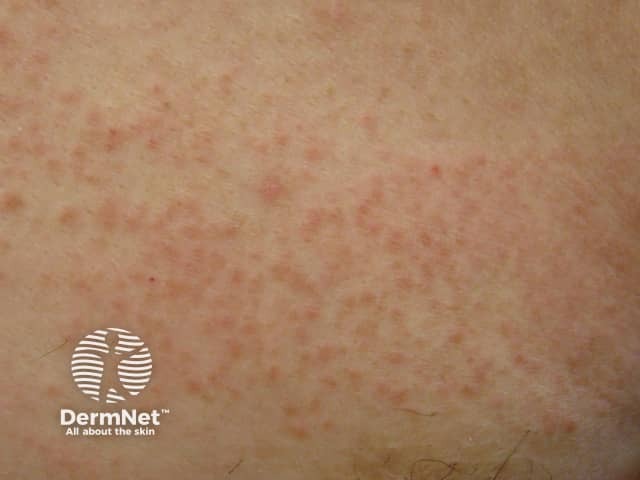 Dermal contact dermatitis