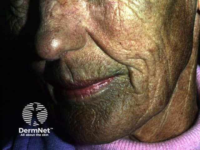 Diffuse facial pigmentation due to a phenothiazine