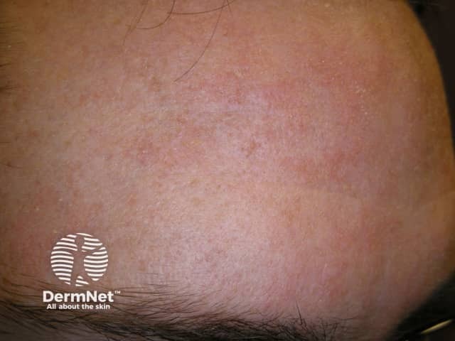 Seborrhoeic eczema