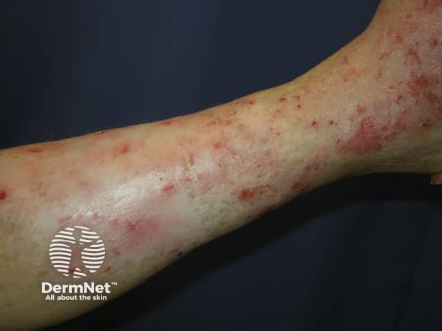 Venous eczema