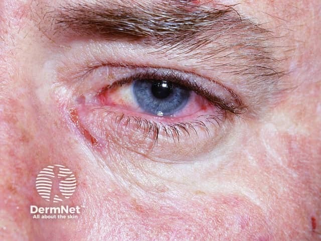 Erythema multiforme of eye