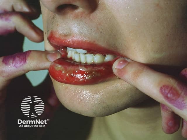 Lip involvement in erythema multiforme