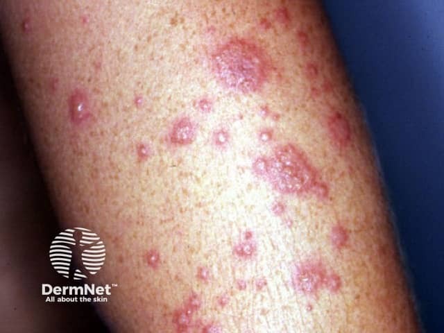 Erythema multiforme