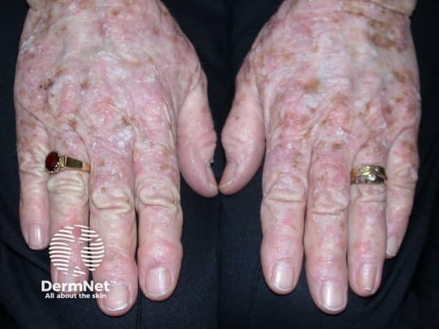 Actinic keratoses