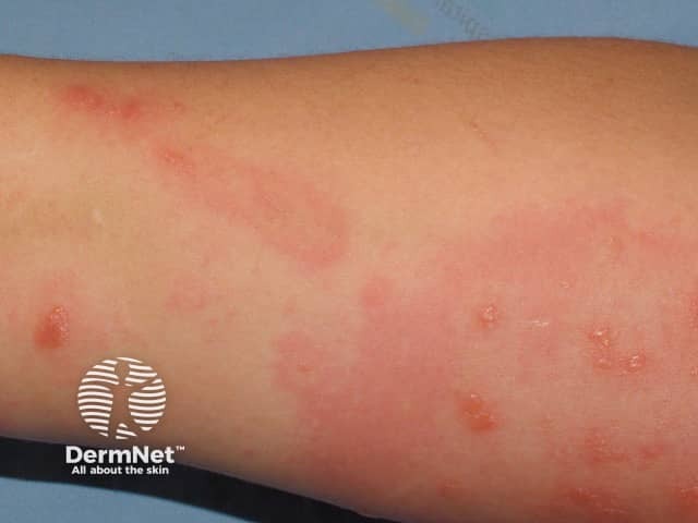 Plant contact dermatitis