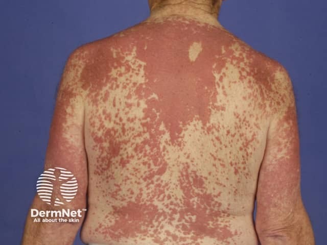 Interstitial granulomatous dermatitis