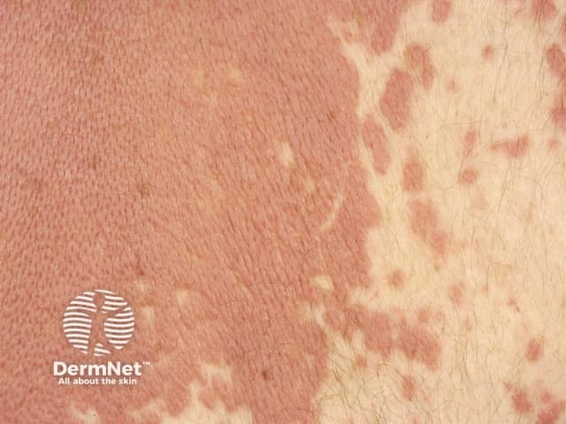 Interstitial granulomatous dermatitis