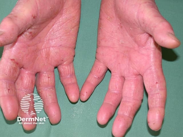 Hand dermatitis in hairdresser