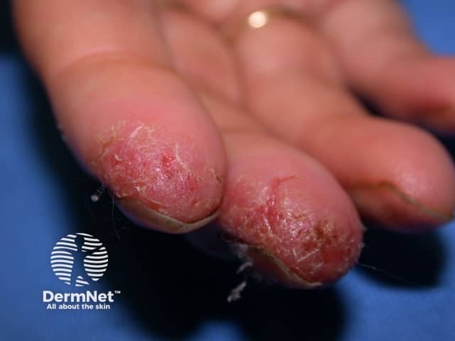 Hand dermatitis in hairdresser