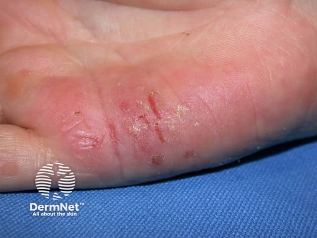 Hand dermatitis in hairdresser