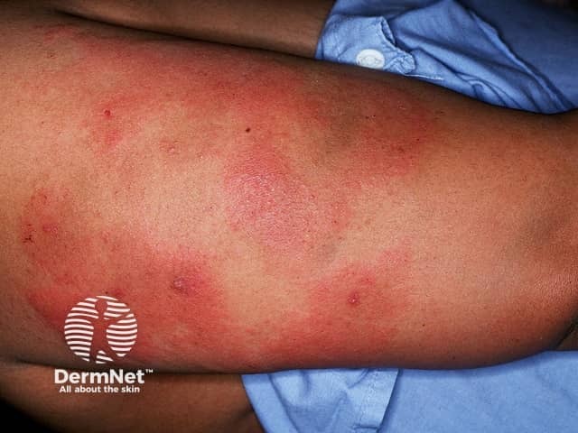 Purpura due to heparin-induced thrombocytopenia