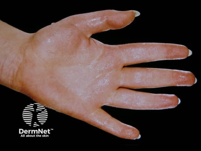 Palmar hyperhidrosis