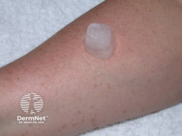 Ice applied to normal skin