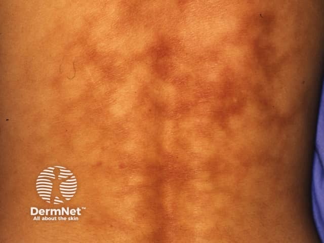 Erythema ab igne