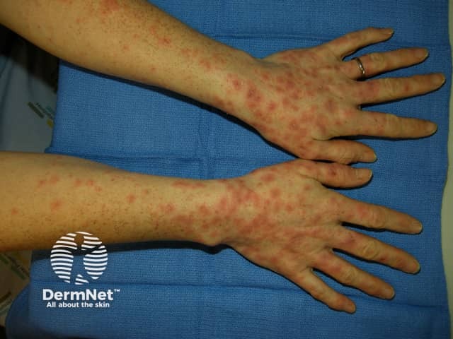 Erythema multiforme