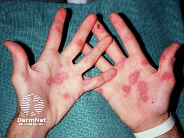 Erythema multiforme