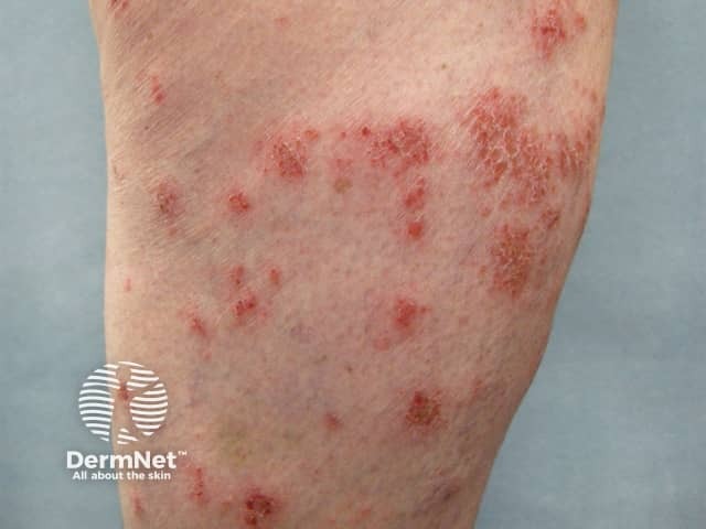 Nummular dermatitis