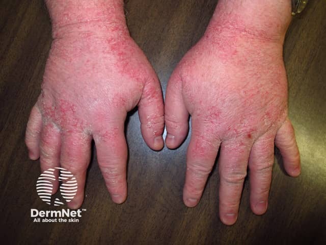 Occupational hand dermatitis